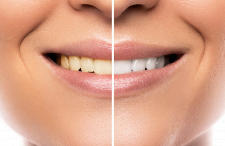 Clareamento dental – qual a melhor opção? - Loyola e Avellar