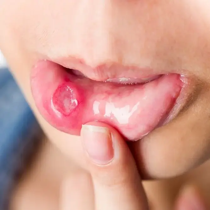 Behçet - úlcera oral