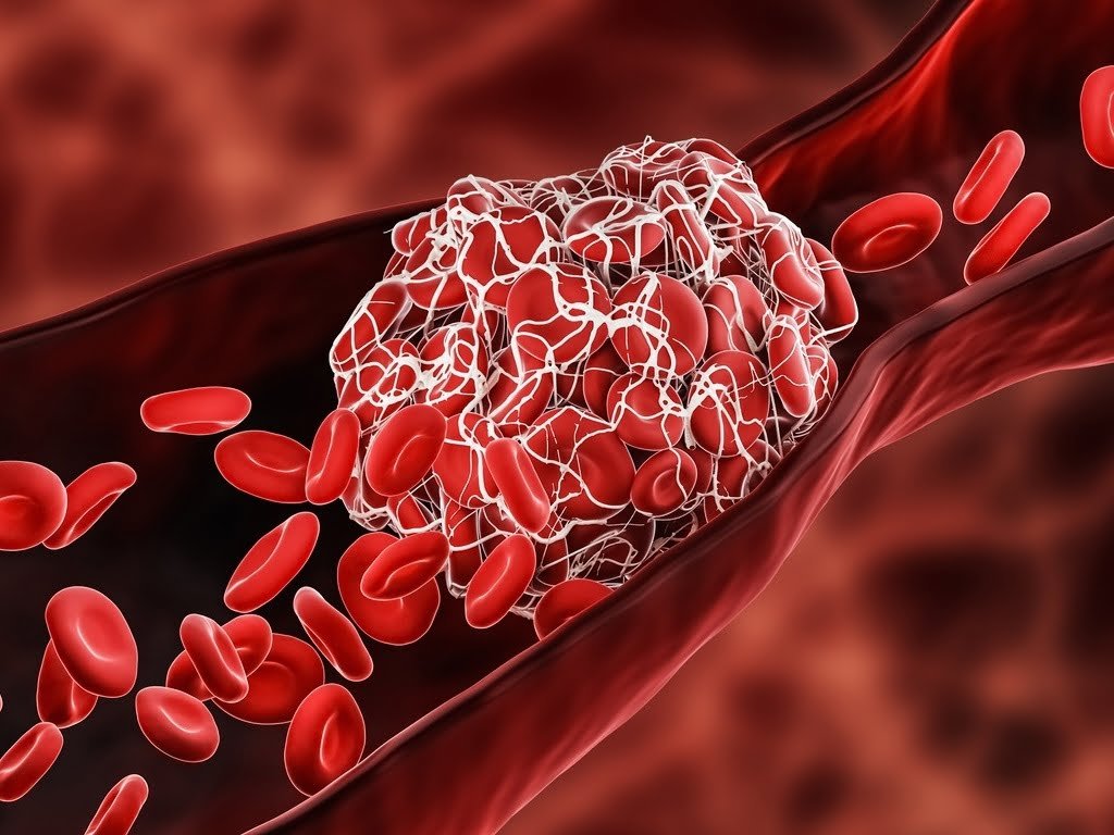 Trombo mural na aorta