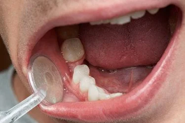 Dente permanente mole - Quais as causas?