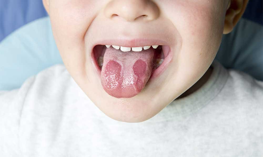 língua geográfica ou glossite migratória