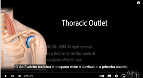 Vídeo ilustrativo da Síndrome do Desfiladeiro Torácico