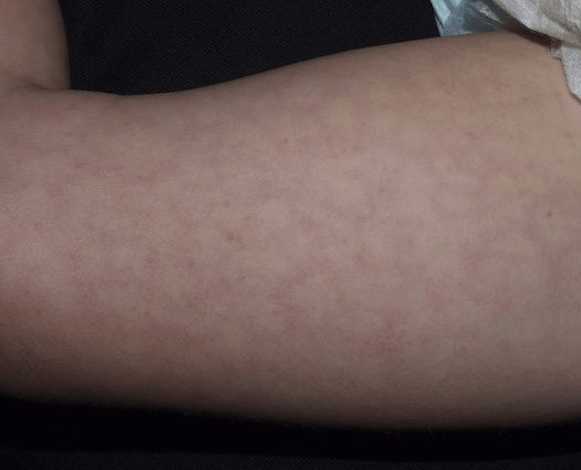 foto livedo reticular