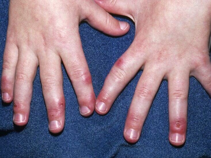 eritema pérnio ou perniose