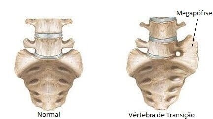 Síndrome de Bertolotti - megapófise