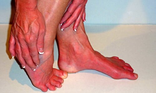 eritromelalgia