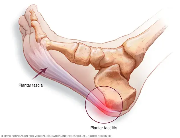 fascite plantar