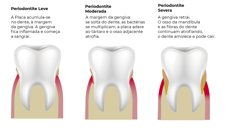 pessoas-com-periodontite-e-covid-19 loyola e avellar covid - 19